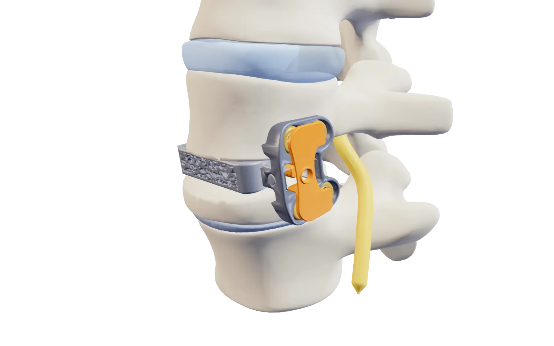 Lateral anatomical rendering of Vertiwedge® positioned within a lumbar vertebral body