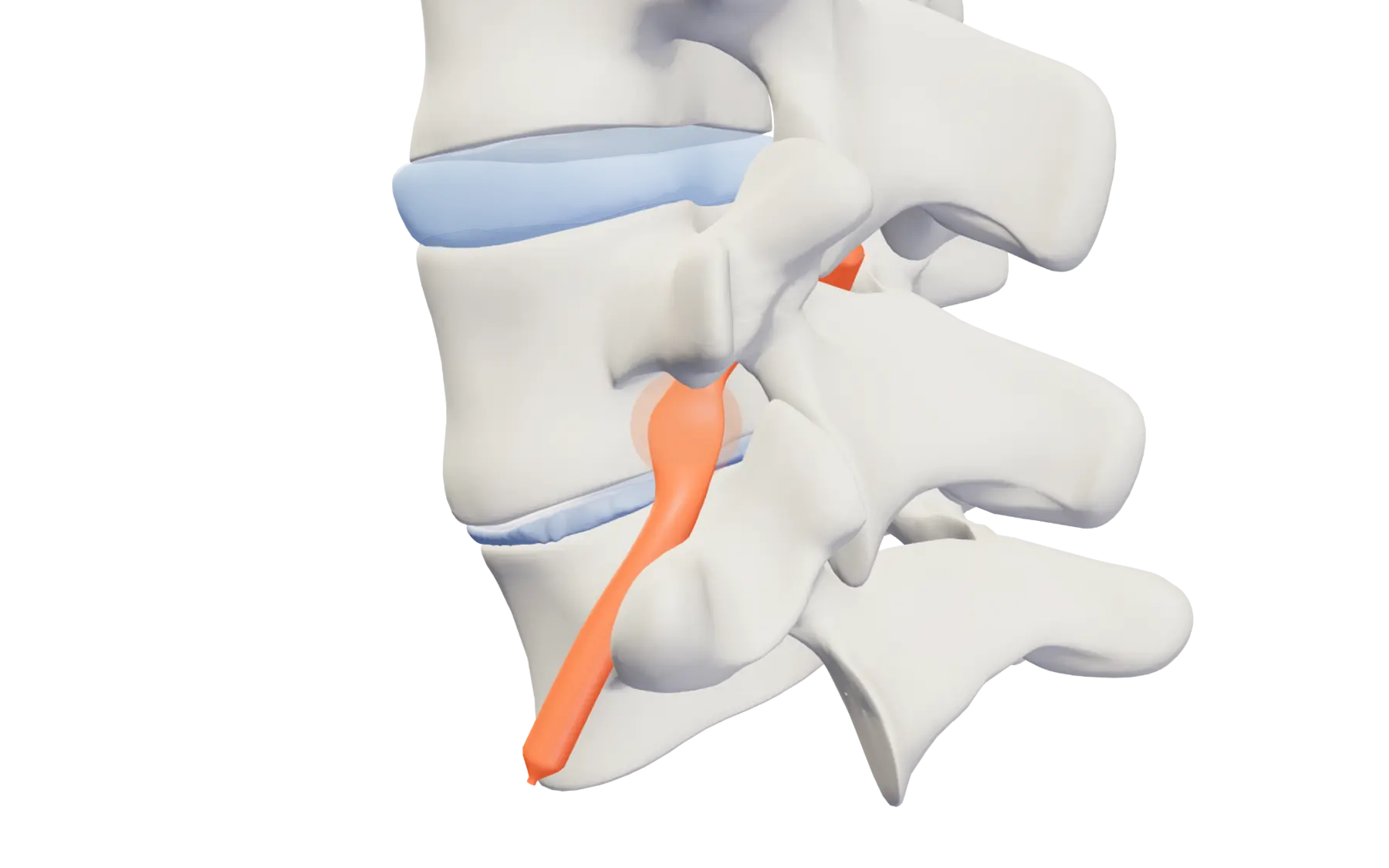Lumbar segment with a narrowed opening where the nerve exits the spine