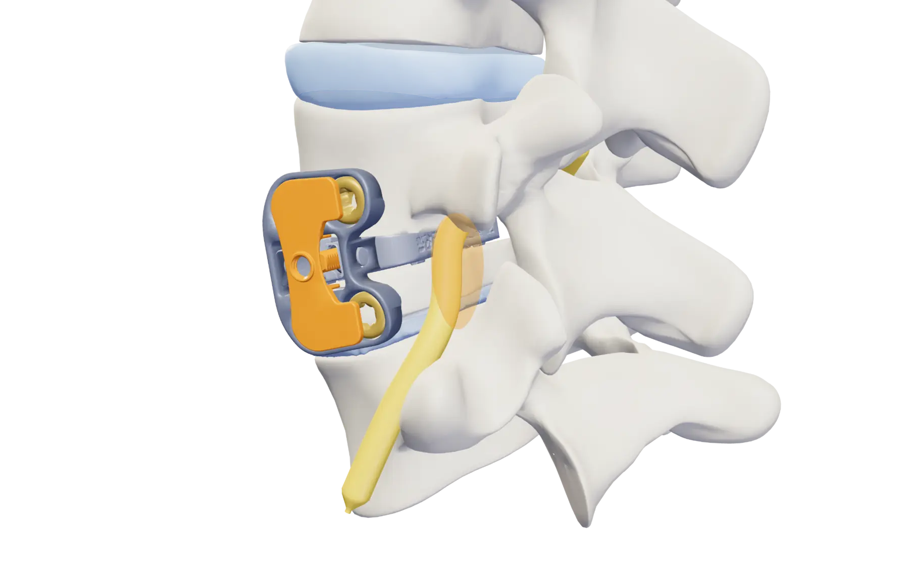 Lumbar segment with Vertiwedge® and an orange guide showing the restored neural foramen