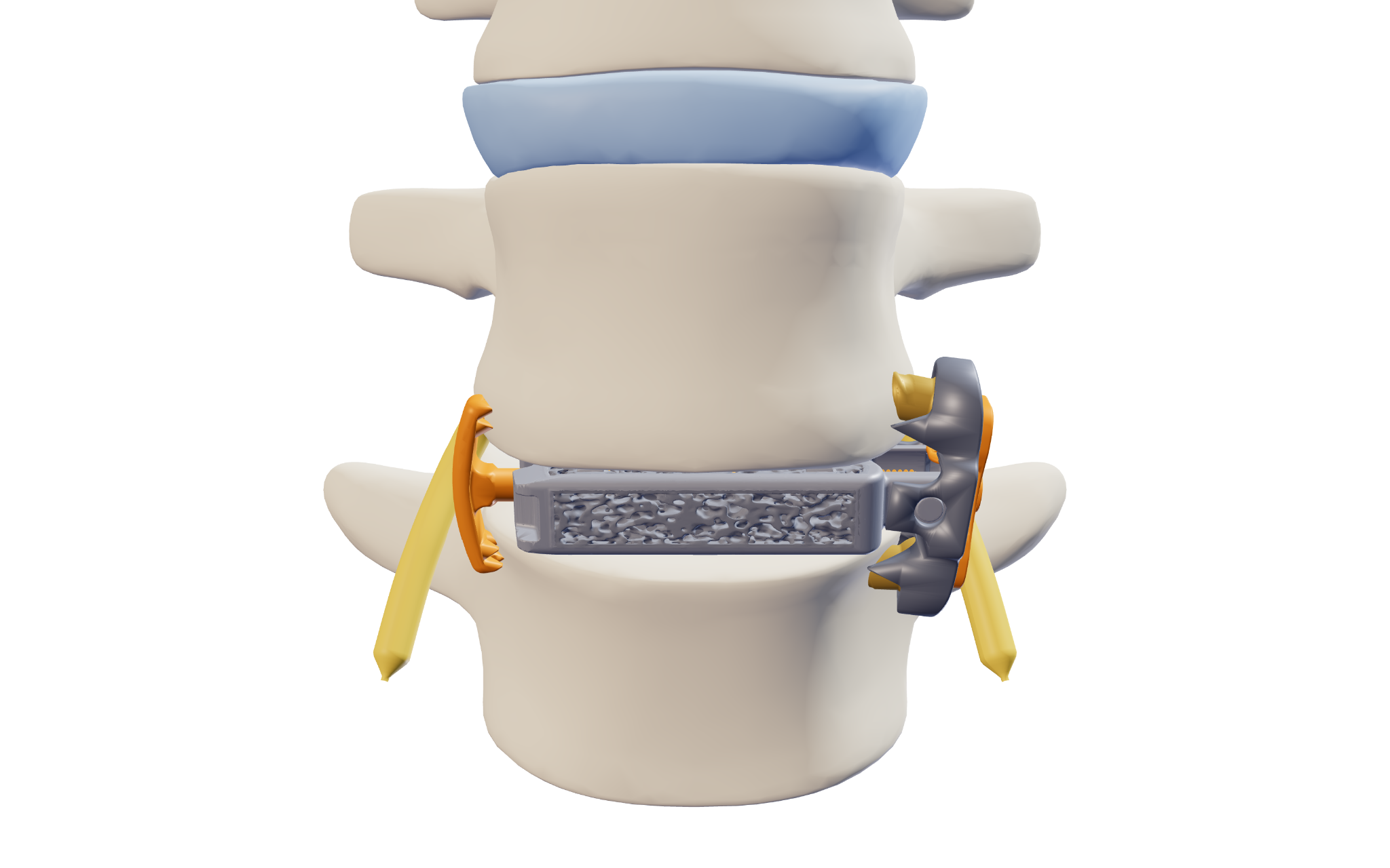 Anterior rendering of Interwedge® implanted in the L4–L5 disc space