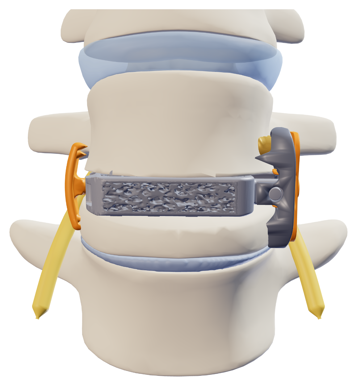 Anterior rendering of Vertiwedge® implanted within the L4 vertebral body
