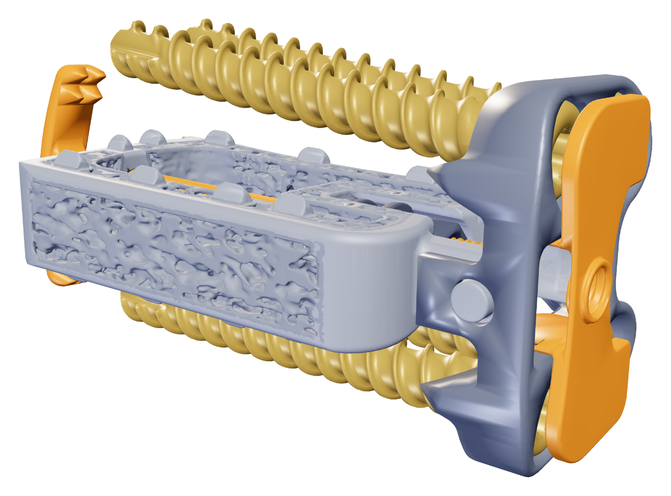 Vertiwedge® intraosseous implant with bone screws, lateral plate, cover plate, and deployable staple