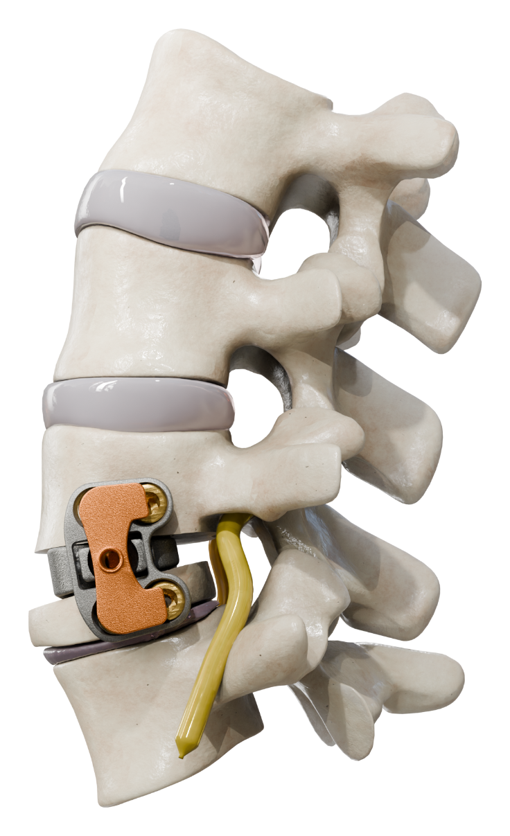 Lumbar segment after VBO showing restored foraminal height around the exiting nerve