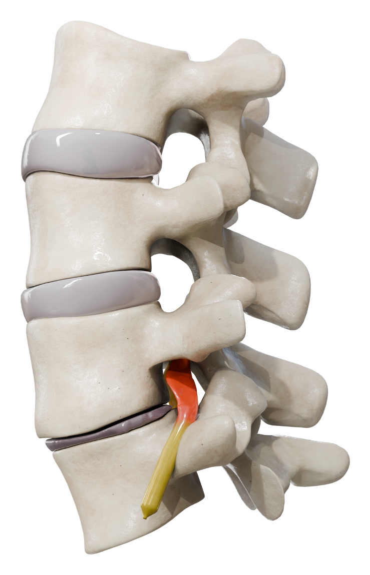 Lumbar segment before VBO showing a compressed exiting nerve