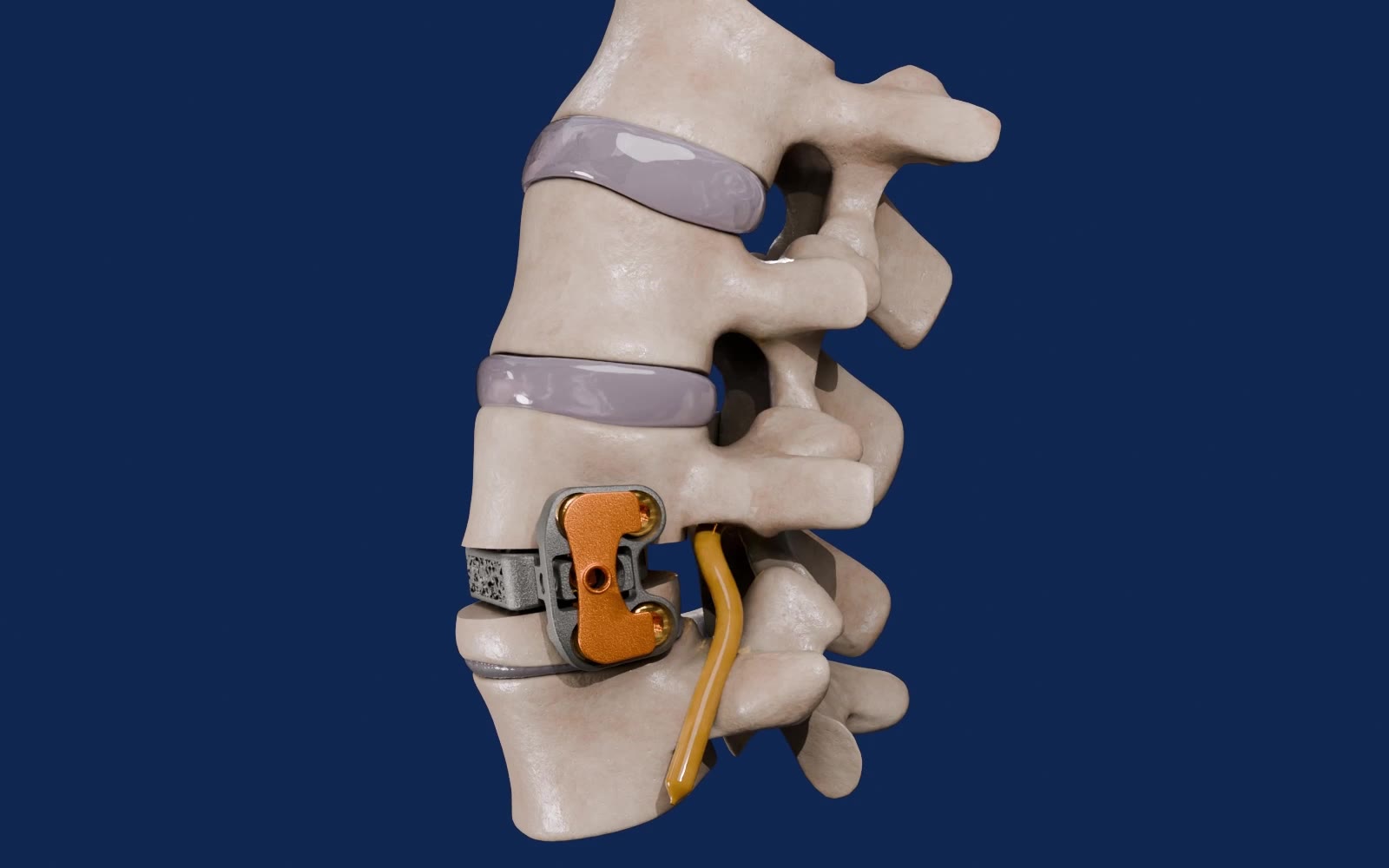 Vertiwedge implanted within the treated vertebral body after the VBO procedure