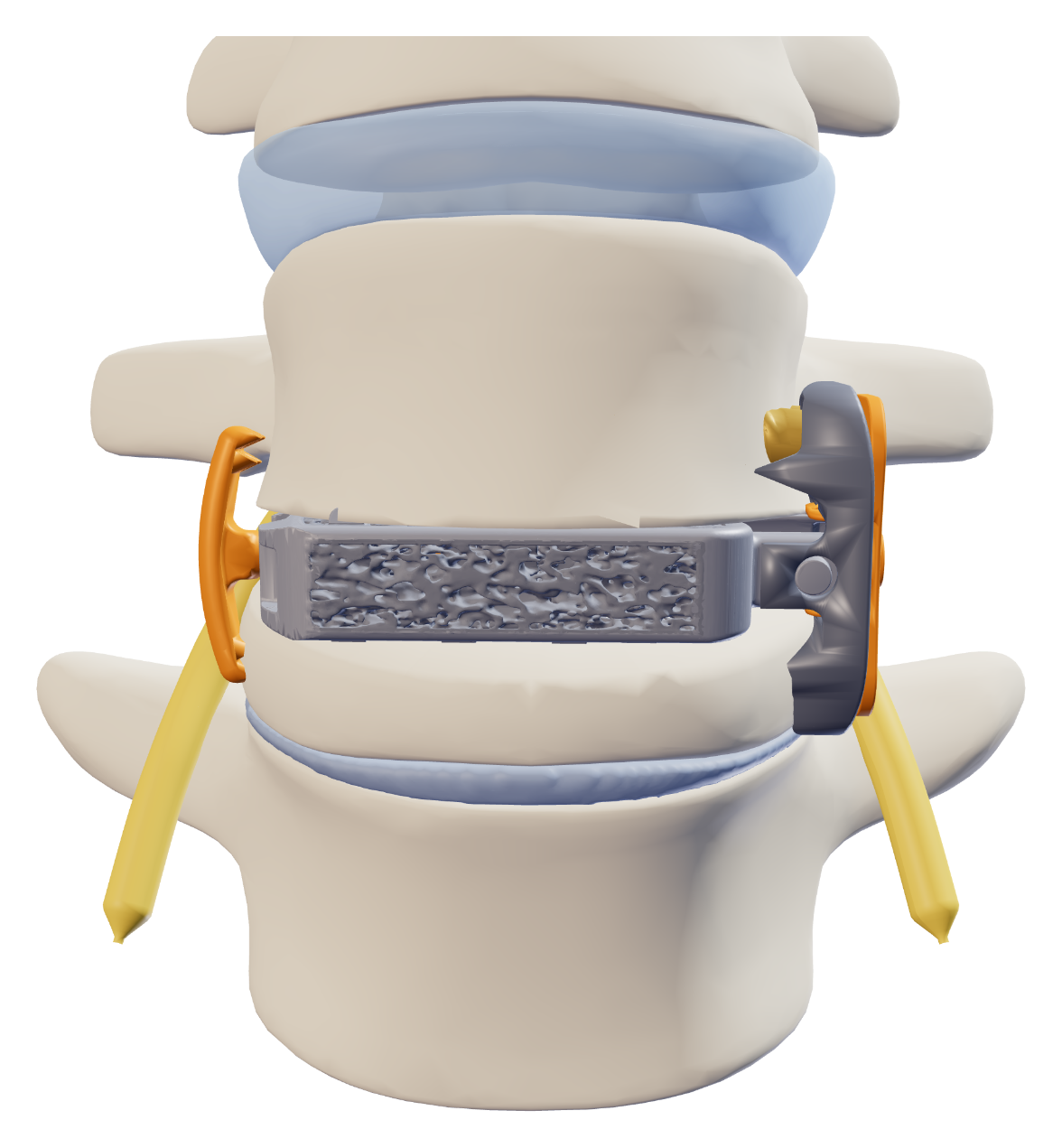 Anterior rendering of Vertiwedge® within L4 showing bilateral fixation