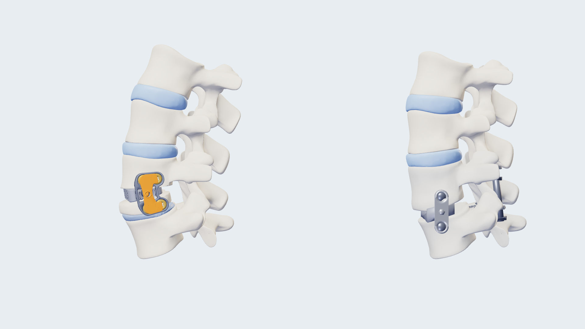 Side-by-side illustration comparing VBO and spinal fusion in a neutral position