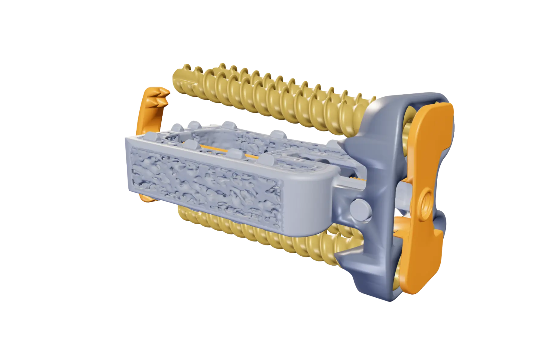Vertiwedge® implant showing the deployable staple, screws, and cover plate
